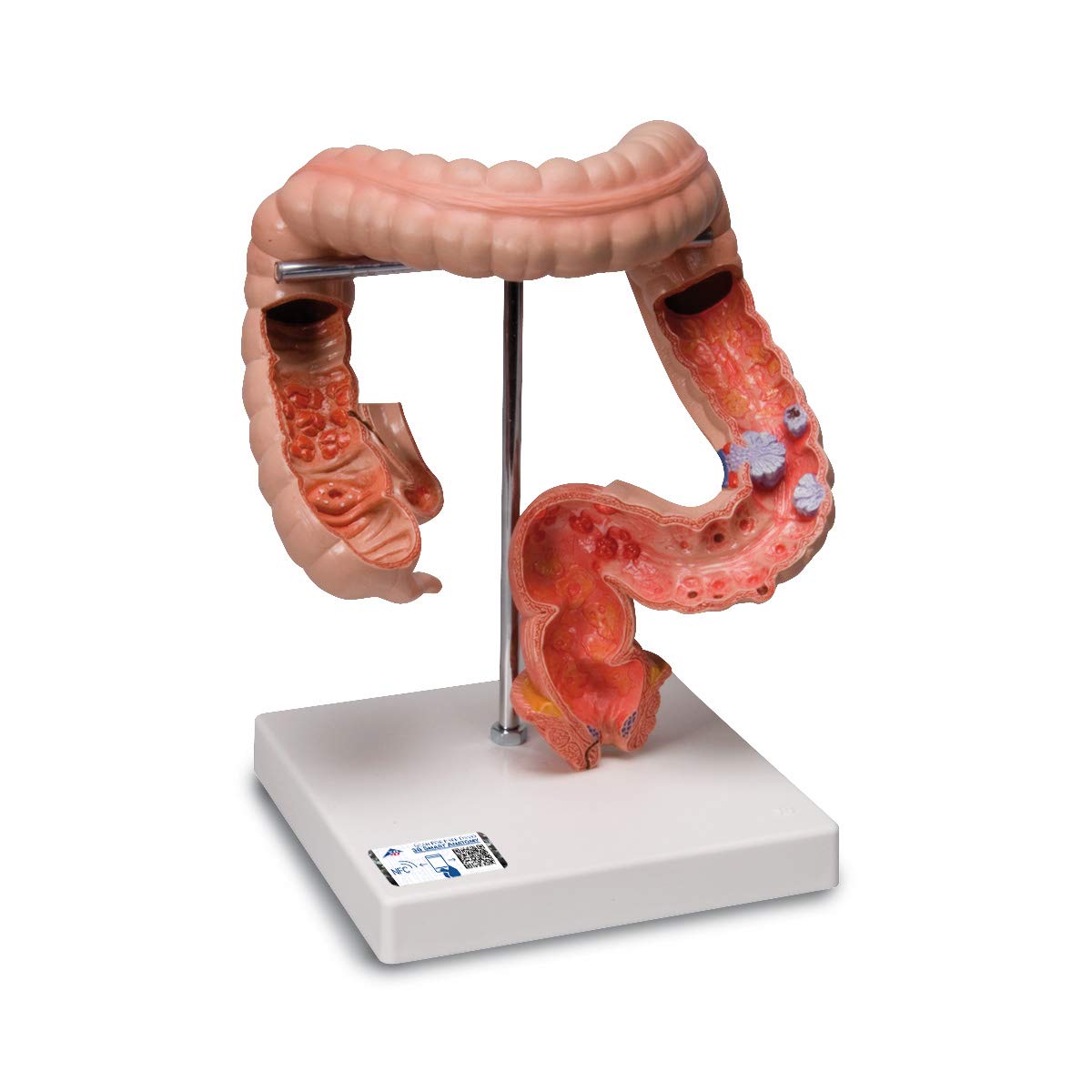 3B Scientific Human Anatomy - مدل پاتولوژیک روده (بزرگ و راست روده) + برنامه رایگان آناتومی - 3B Smart Anatomy، K55