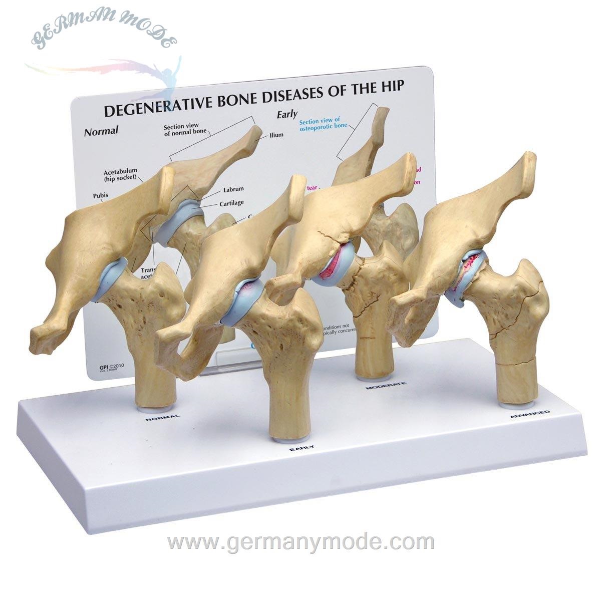 مدل تشریحی بیماری‌های دژنراتیو استخوانی مفصل لگن GPI Anatomicals 1320 بیماری های دژنراتیو استخوان مدل هیپ