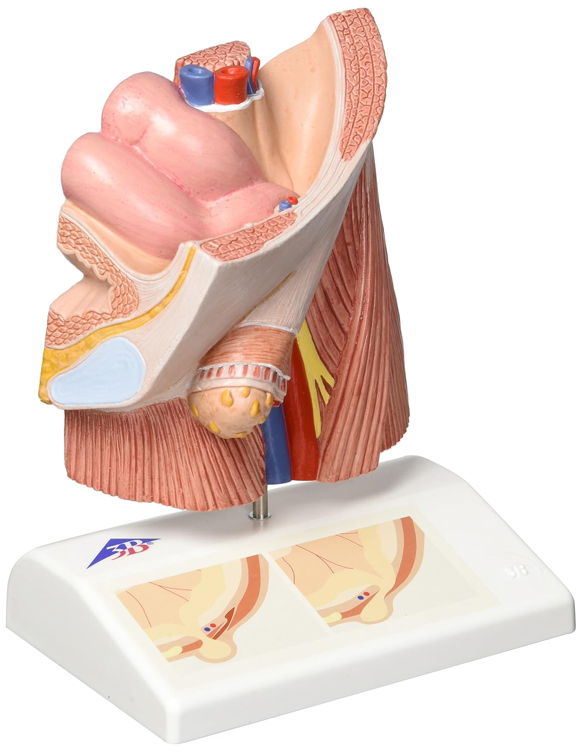 مدل تشریحی فتق کشاله ران 3B Scientific به همراه اپلیکیشن رایگان 3B Smart Anatomy فتق مغبنی
