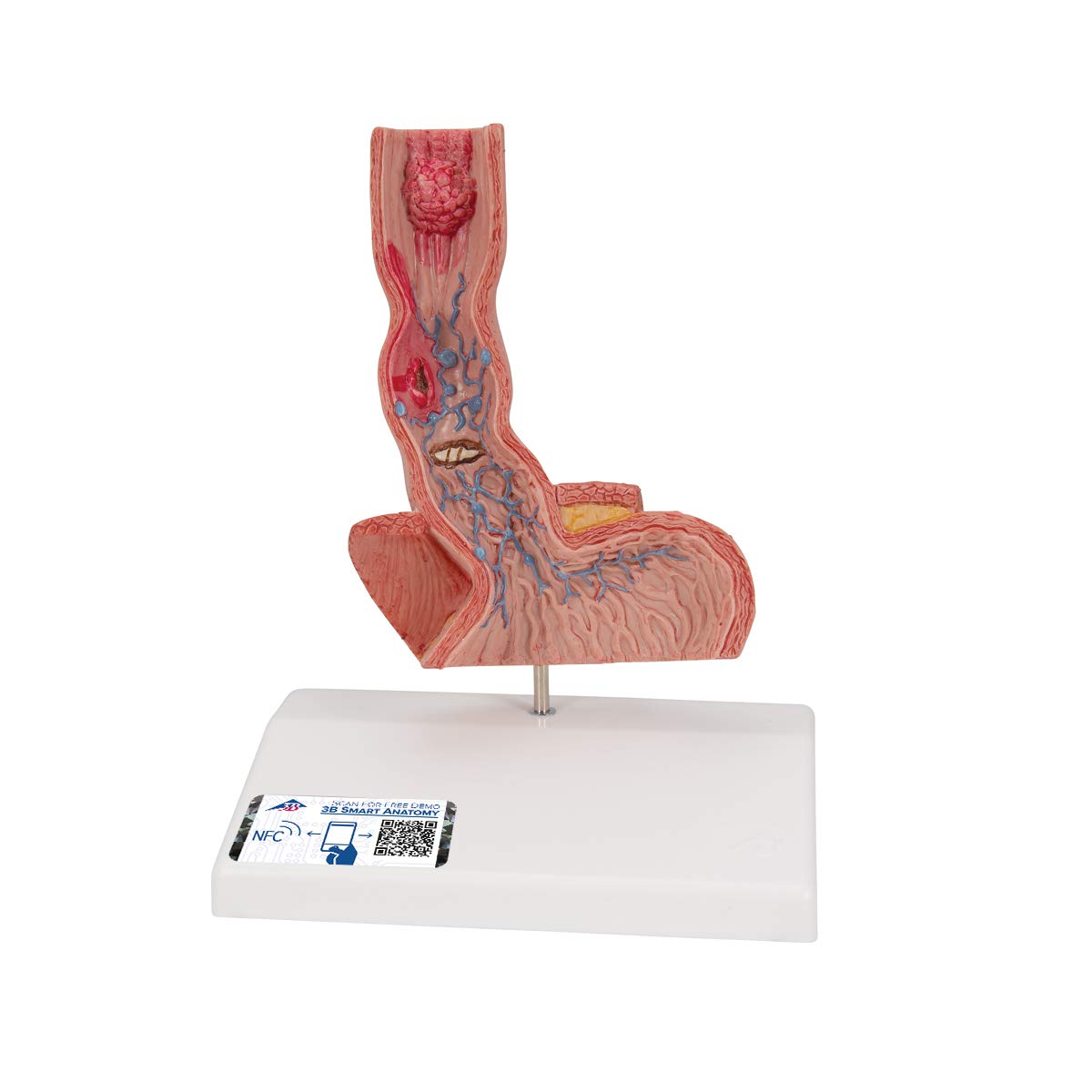 3B علمی آناتومی انسان - بیماری های مری + برنامه رایگان آناتومی - 3B Smart Anatomy