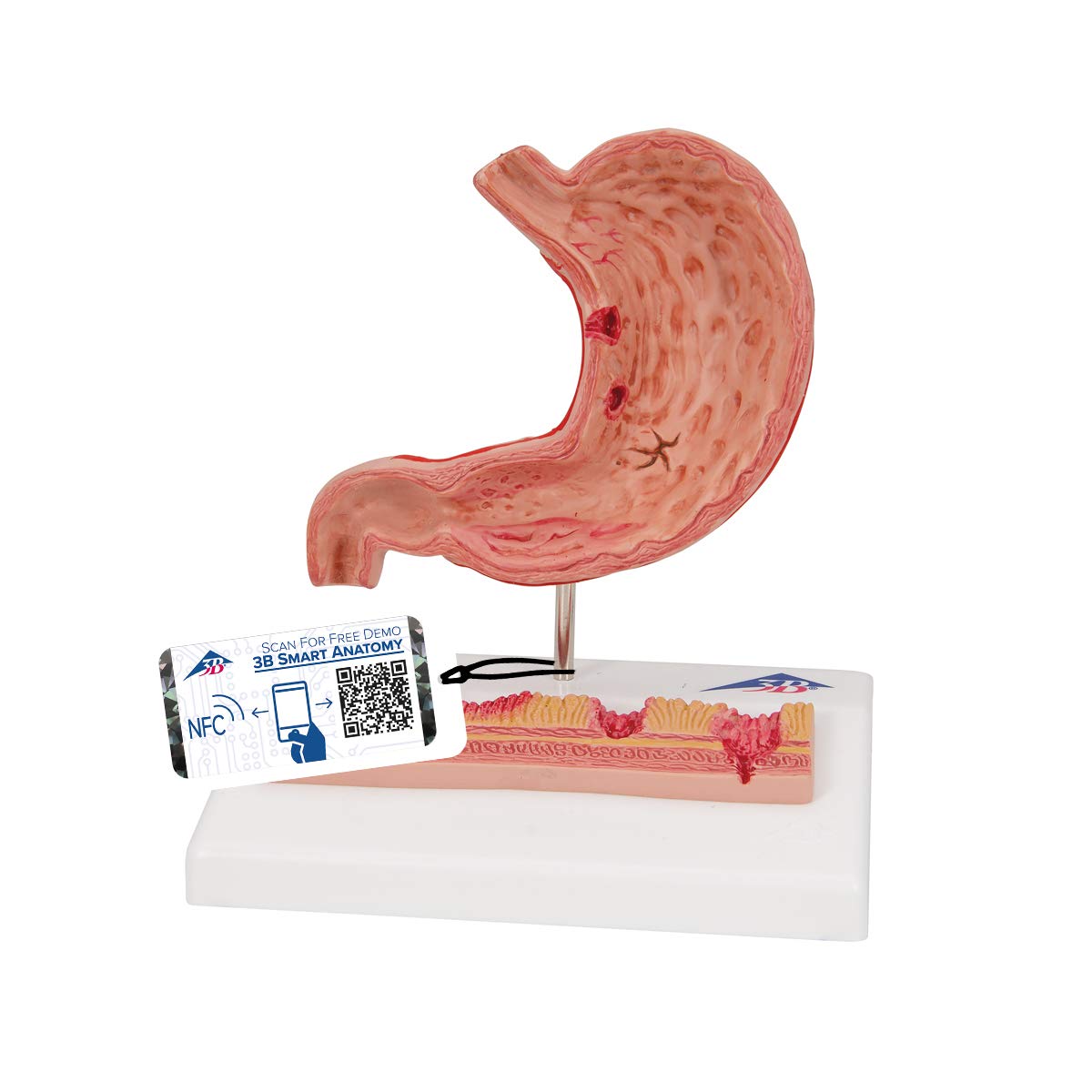 3B Scientific Human Anatomy - معده با زخم معده + برنامه رایگان آناتومی - 3B Smart Anatomy