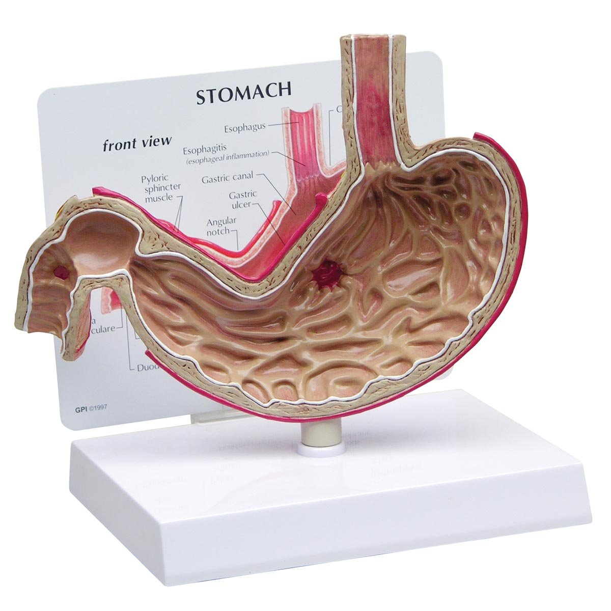 GPI Anatomicals 2000 مدل معده با زخم