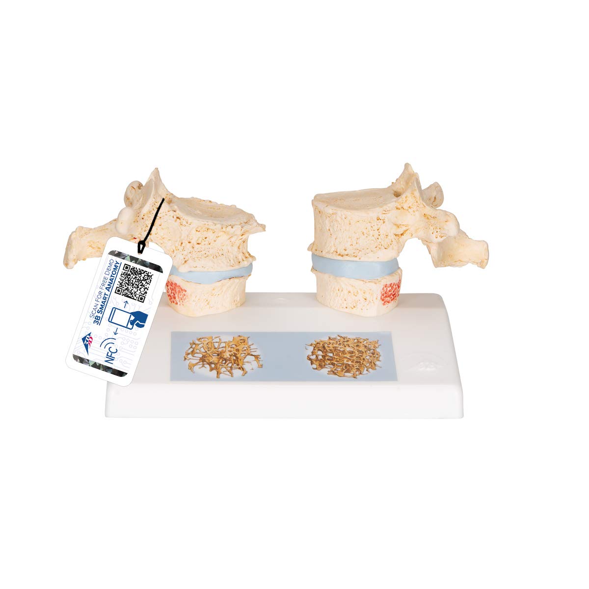 3B Scientific Human Anatomy - مدل پوکی استخوان + اپلیکیشن رایگان آناتومی - 3B Smart Anatomy