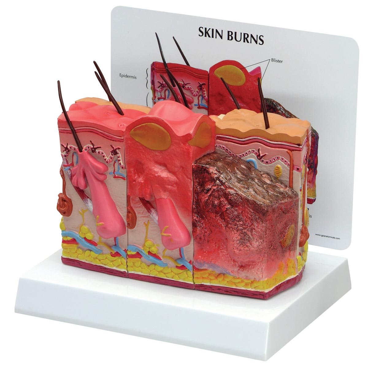 GPI Anatomicals W33372 Skin Model Normal and Burns, 1019569