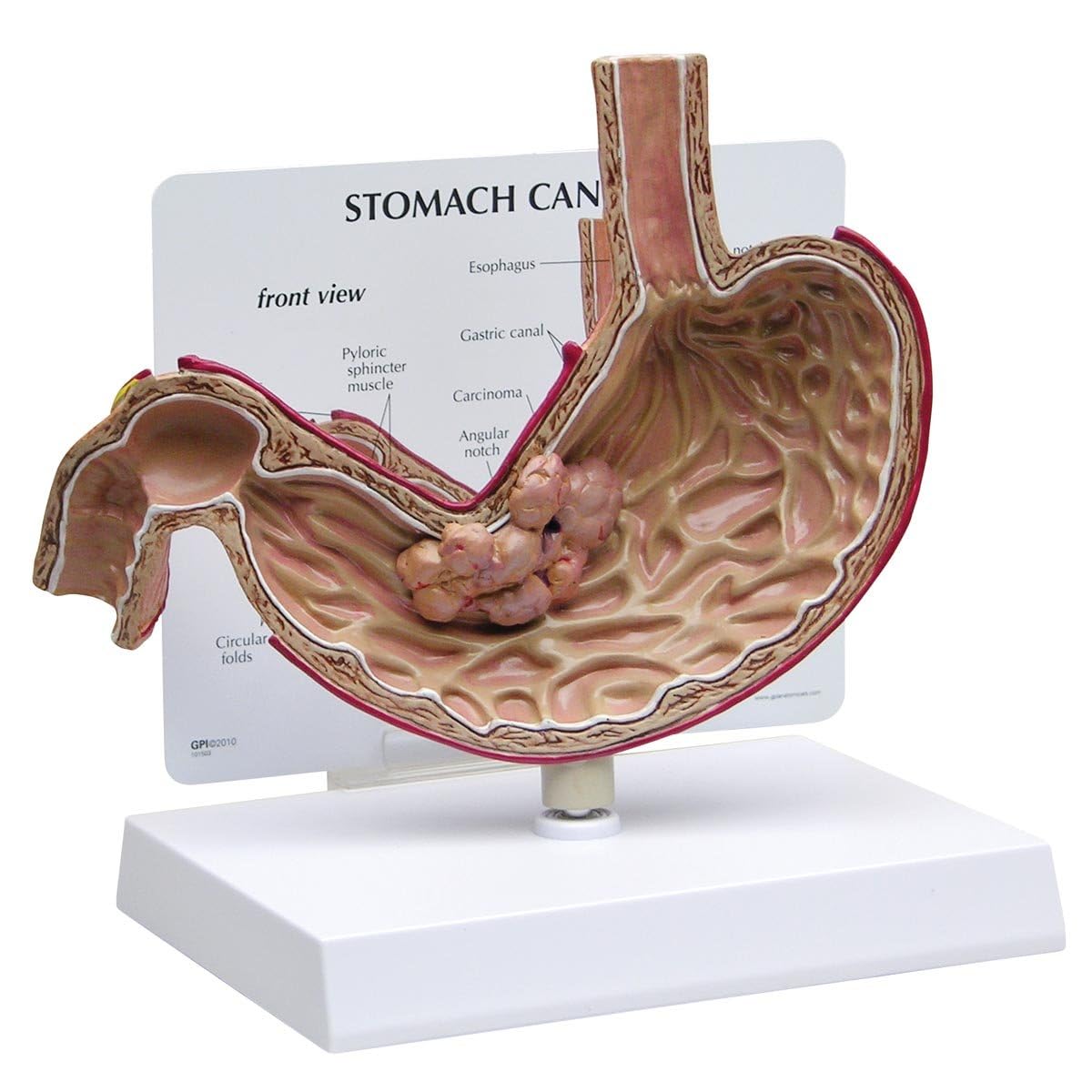 مدل سرطان معده GPI Anatomicals 2001