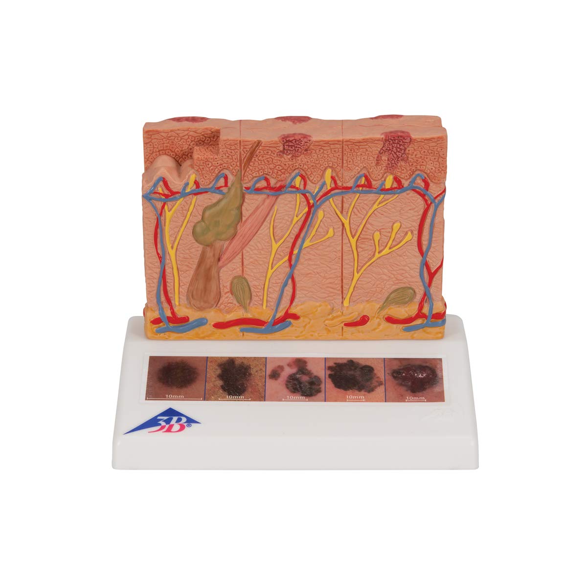 3B Scientific Human Anatomy - مدل سرطان پوست + برنامه رایگان آناتومی - 3B Smart Anatomy, J15