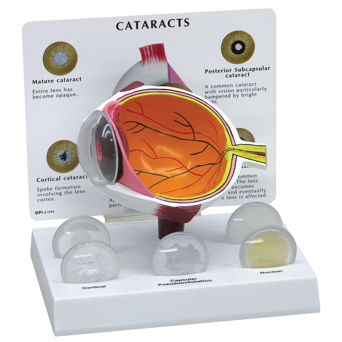 GPI Anatomicals W47852 مدل چشم آب مروارید، آب مروارید