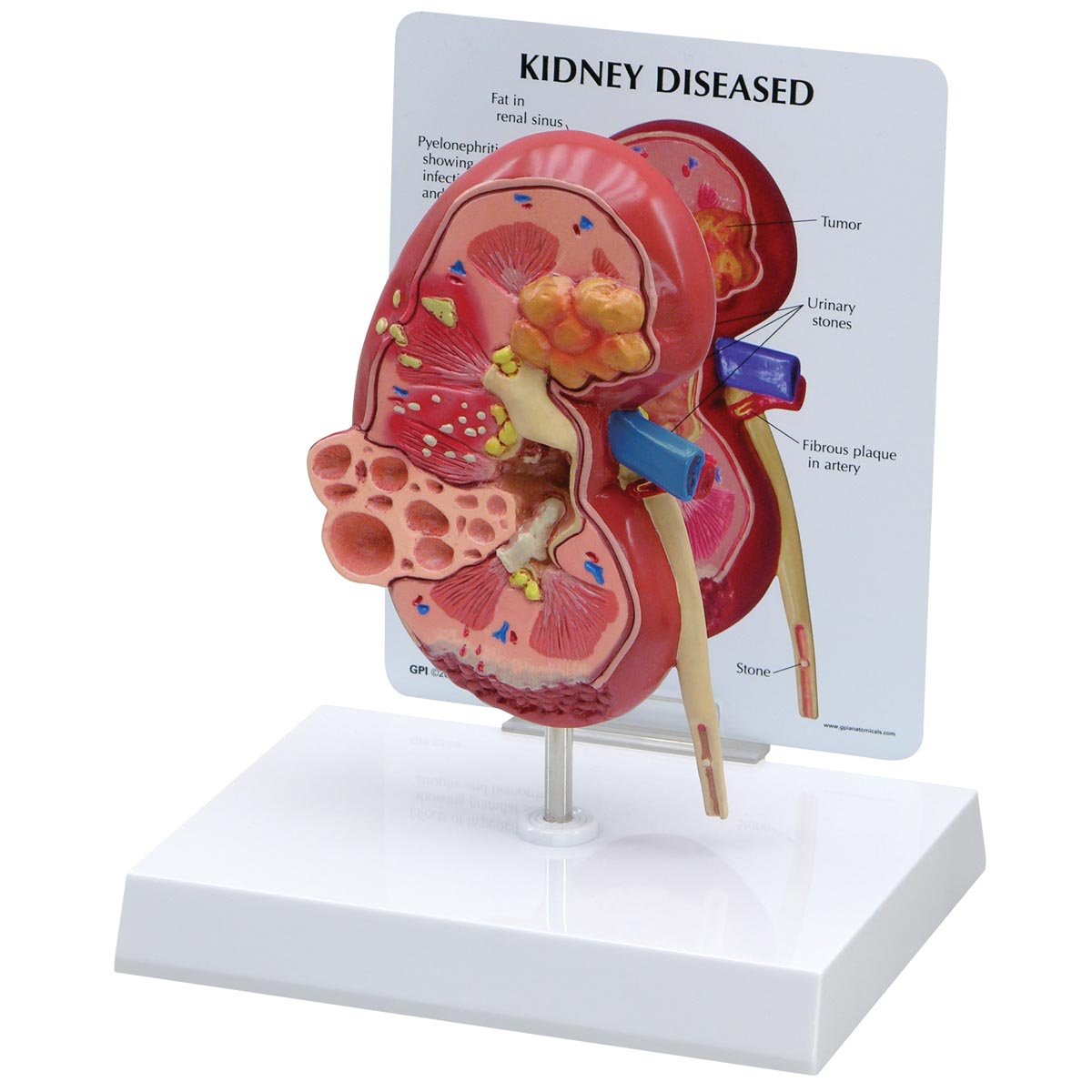 GPI Anatomicals 3260 Kidney Model Normal with Disease