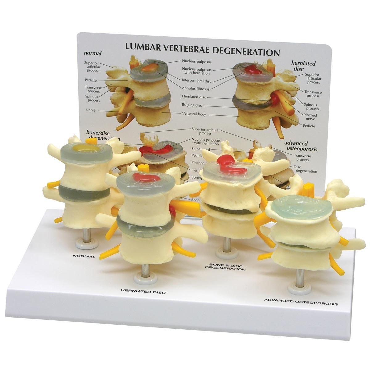 مدل تشریحی ستون فقرات GPI Anatomicals مدل 1760 در مراحل مختلف