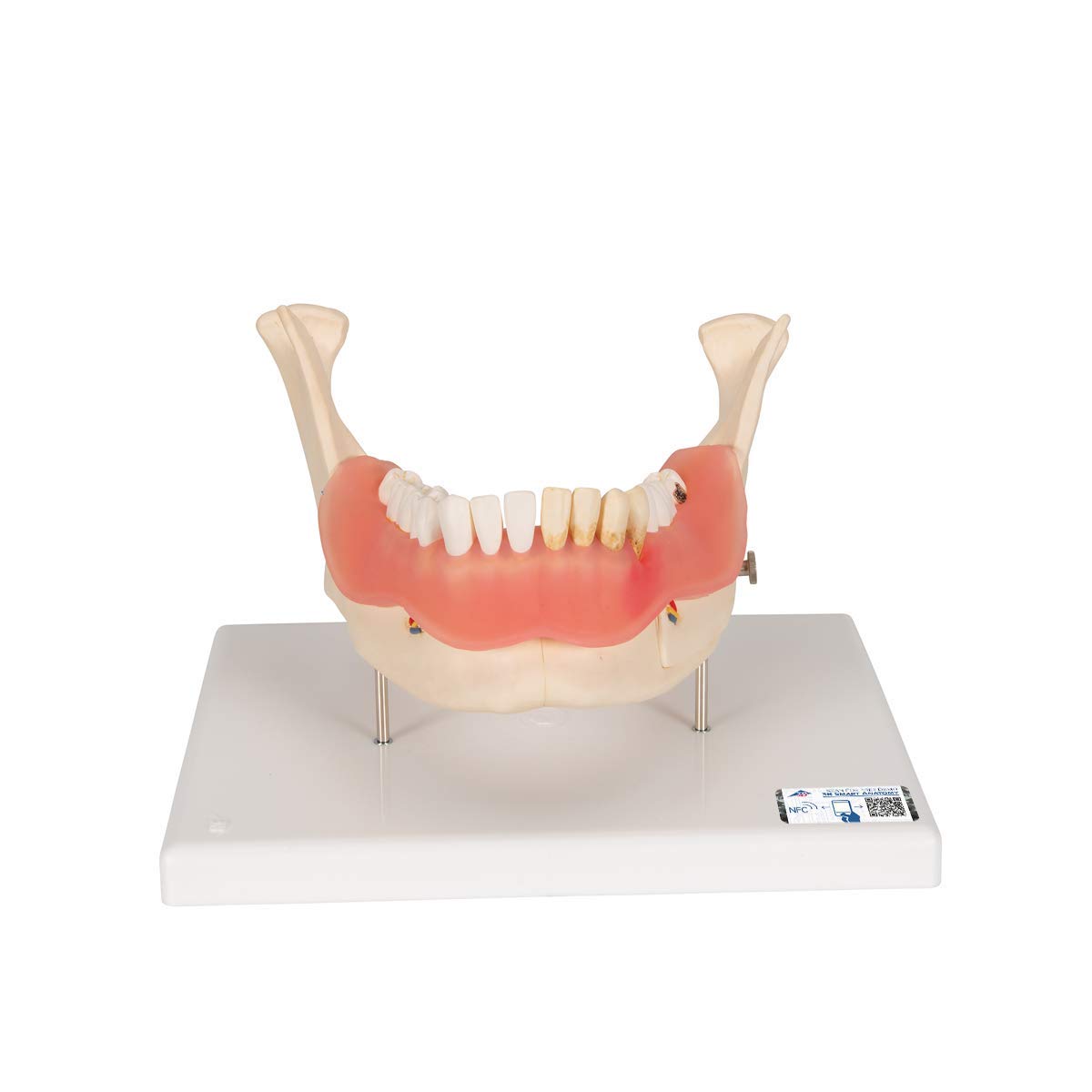 مدل تشریحی بیماری‌های دندانی انسان 3B Scientific، اندازه 2 برابر طبیعی، 21 تکه + اپلیکیشن رایگان 3B Smart Anatomy