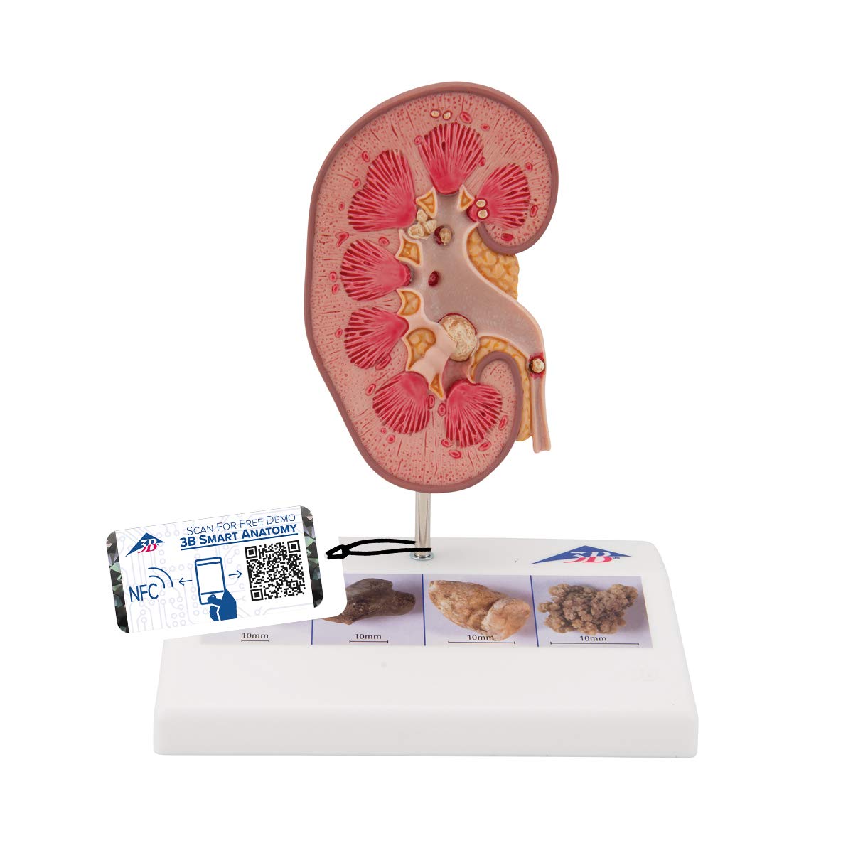 مدل تشریحی سنگ کلیه 3B Scientific همراه با اپلیکیشن رایگان 3B Smart Anatomy، مدل K29