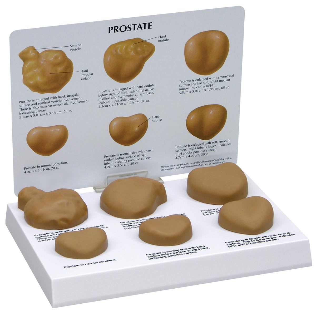 مدل تشریحی پروستات GPI Anatomicals W33366