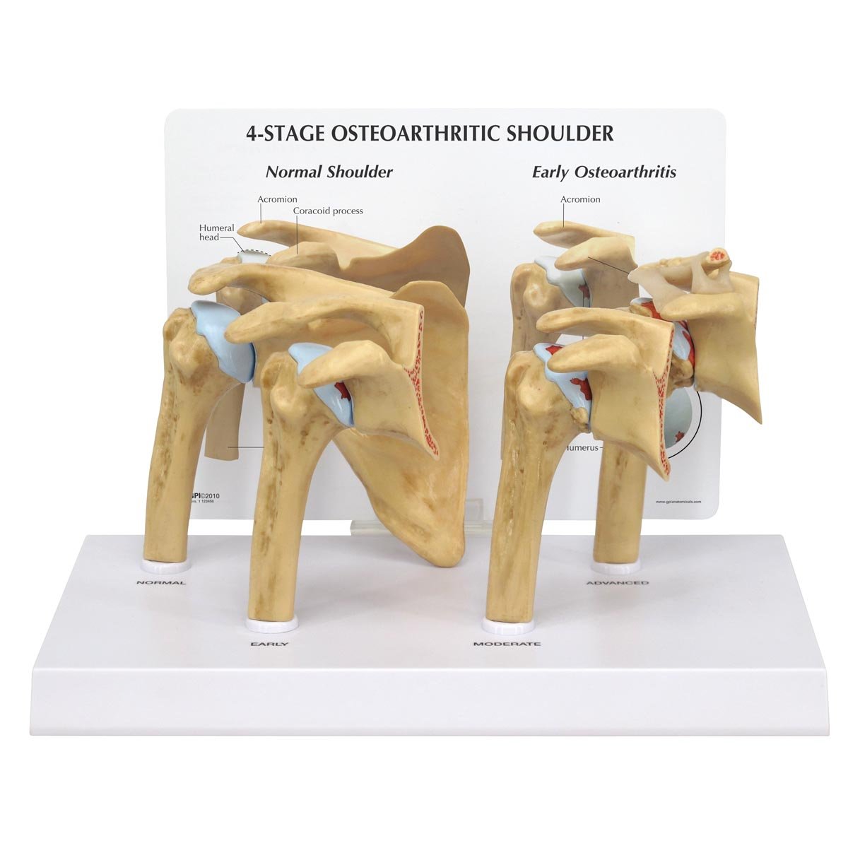 مدل GPI Anatomicals 1800 Schuler، آرتروز 4 مرحله ای