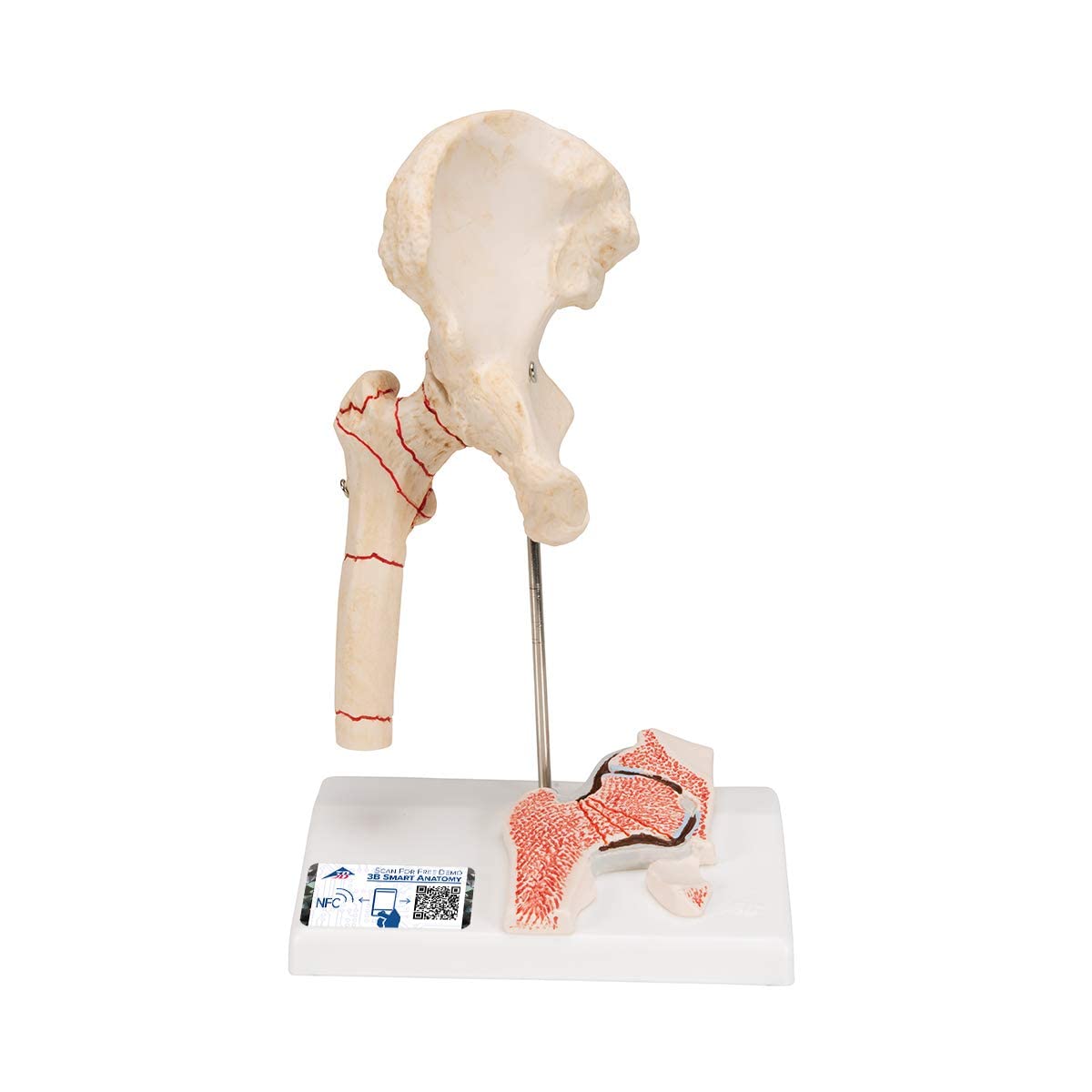 3B Scientific Human Anatomy - شکستگی استخوان ران و پوشیدن مفصل ران + برنامه رایگان آناتومی - 3B Smart Anatomy