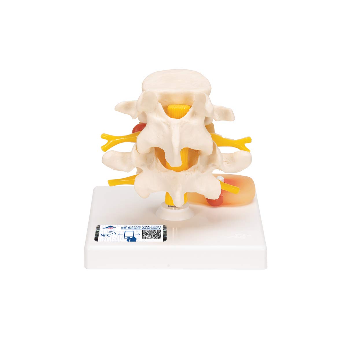 مدل تشریحی ستون فقرات کمری با فتق دیسک + اپلیکیشن آناتومی رایگان 3B Smart Anatomy