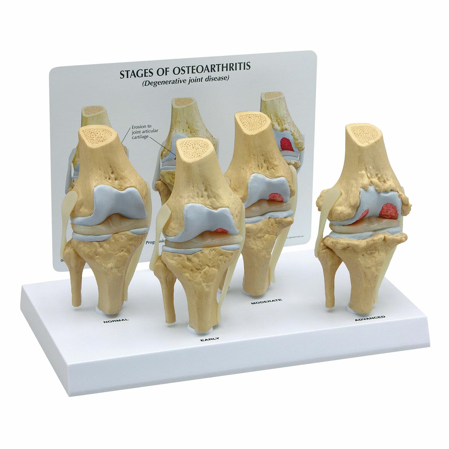 ست مدل زانو GPI Anatomicals 1100 Osteo 4 مرحله مختلف