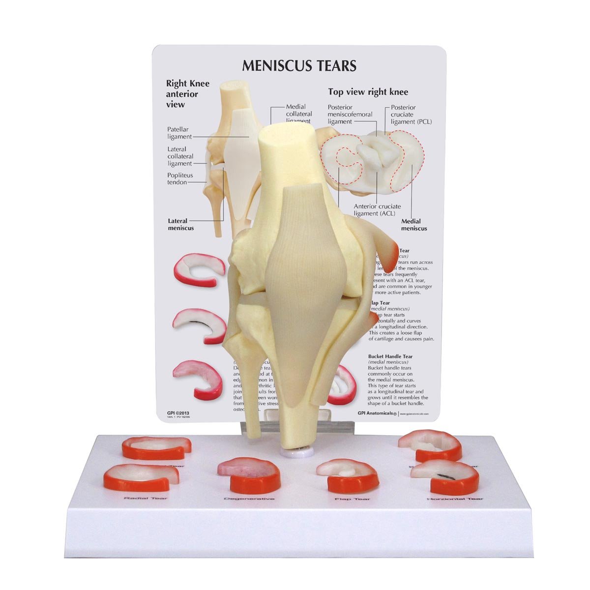GPI Anatomicals 1010 مدل زانو منیسک با 6 پارگی