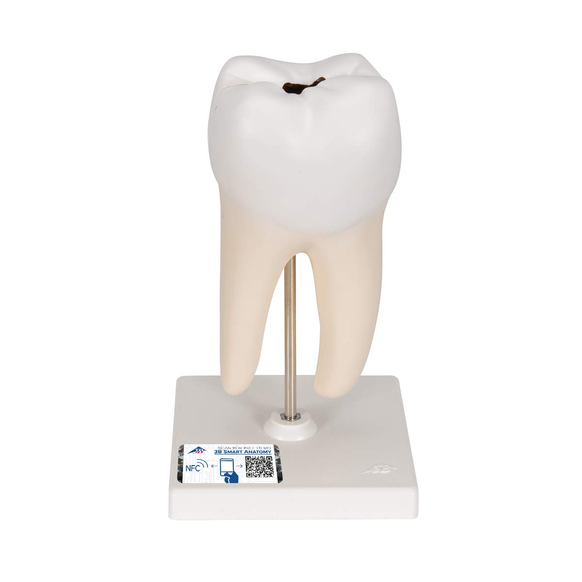 مدل تشریحی دندان مولار دو ریشه‌ای پایین با پوسیدگی 3B Scientific، 2 تکه + اپلیکیشن رایگان 3B Smart Anatomy