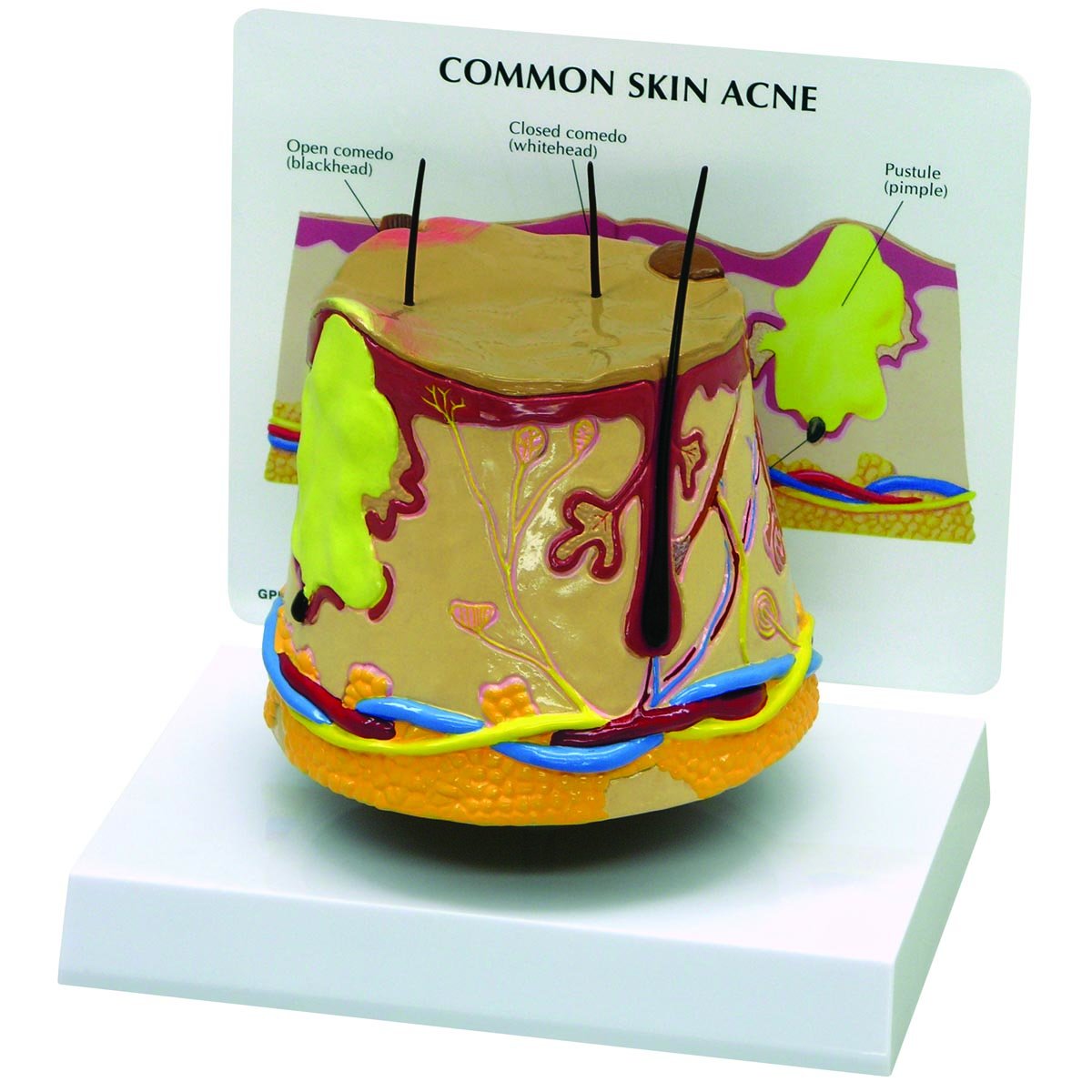 GPI Anatomicals 3750 Skin Model Acne